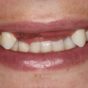 Dental Care Smile Before Intervention Missing front teeth