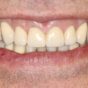 Charming Smile after Dental Intervention