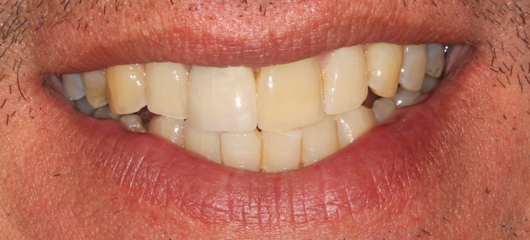 Patient Smile after Intervention