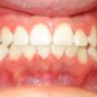 Dental Care Intervention Smile