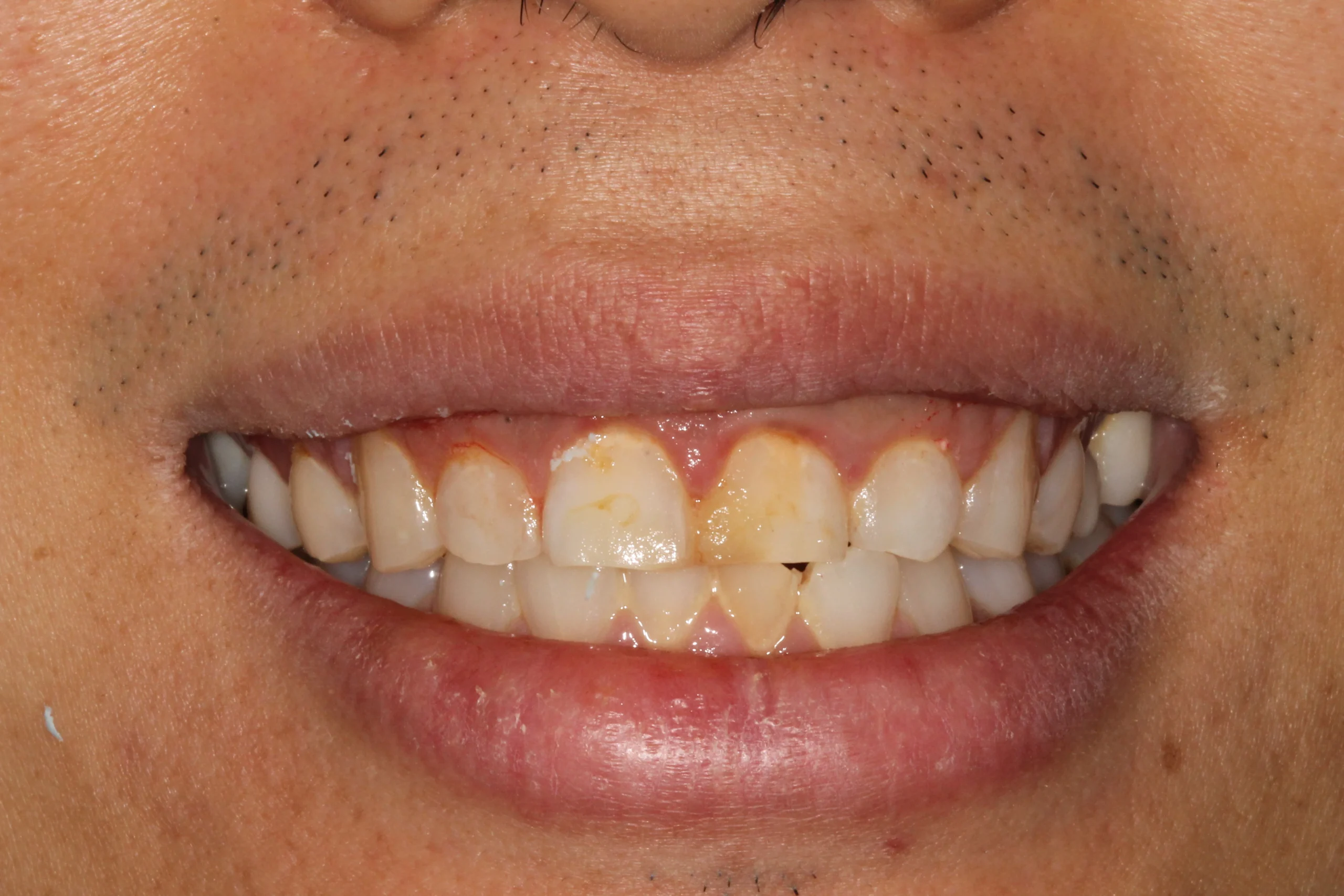 Close-up of teeth with discoloration and plaque buildup