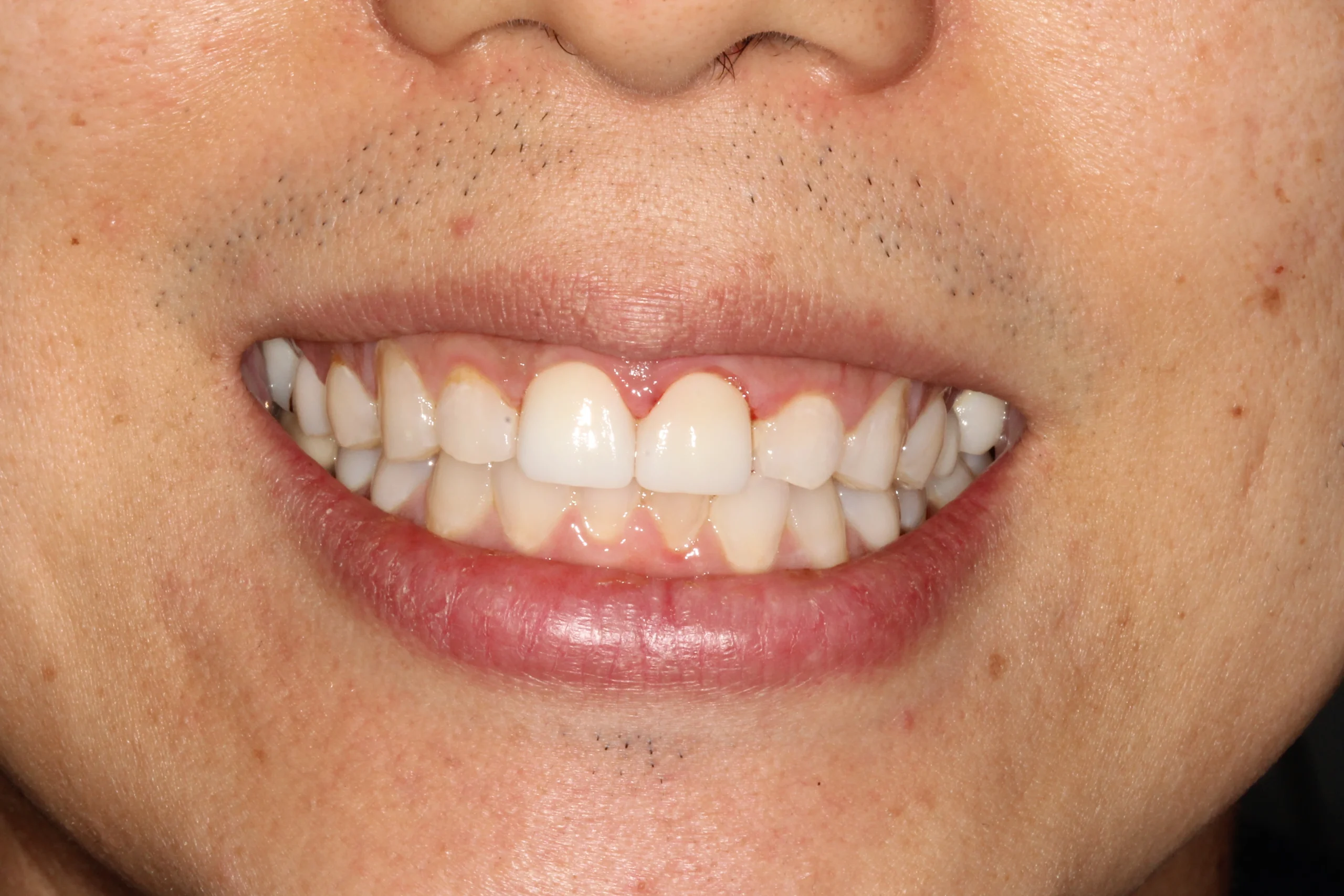 Close-up of teeth after crown treatment, appearing whiter and healthier