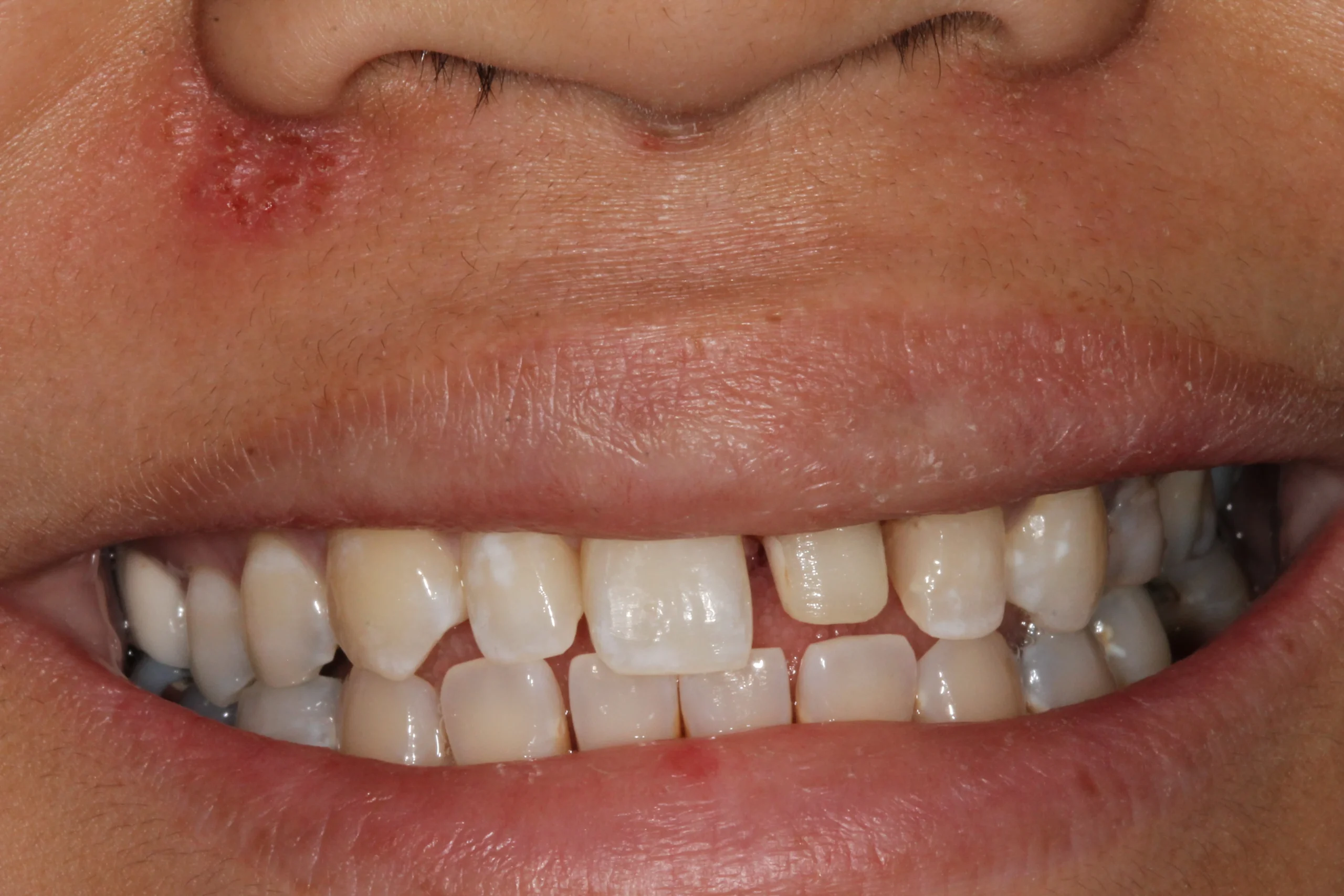 Close-up of teeth with uneven spacing