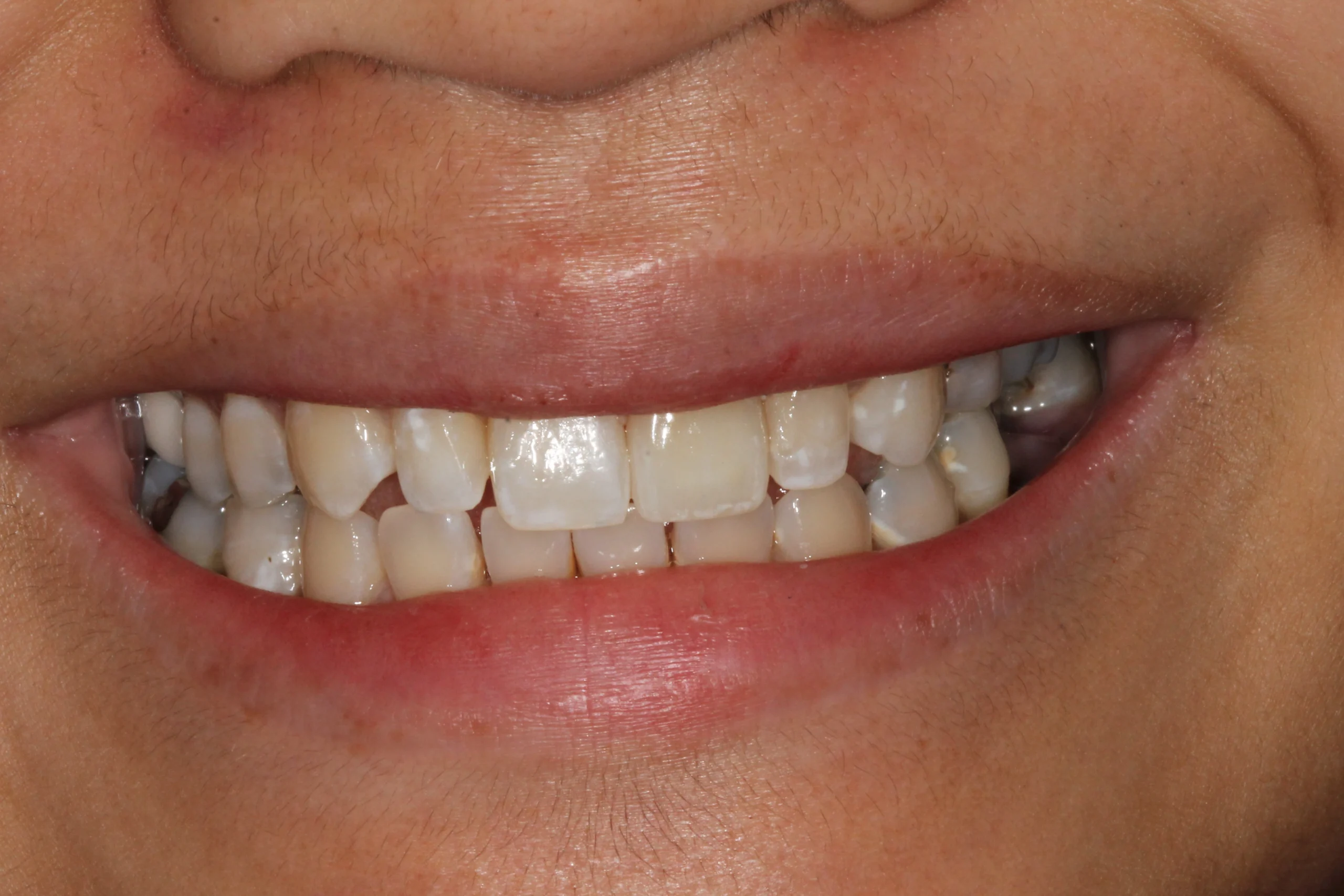 Close-up of teeth after crown treatment, with improved alignment