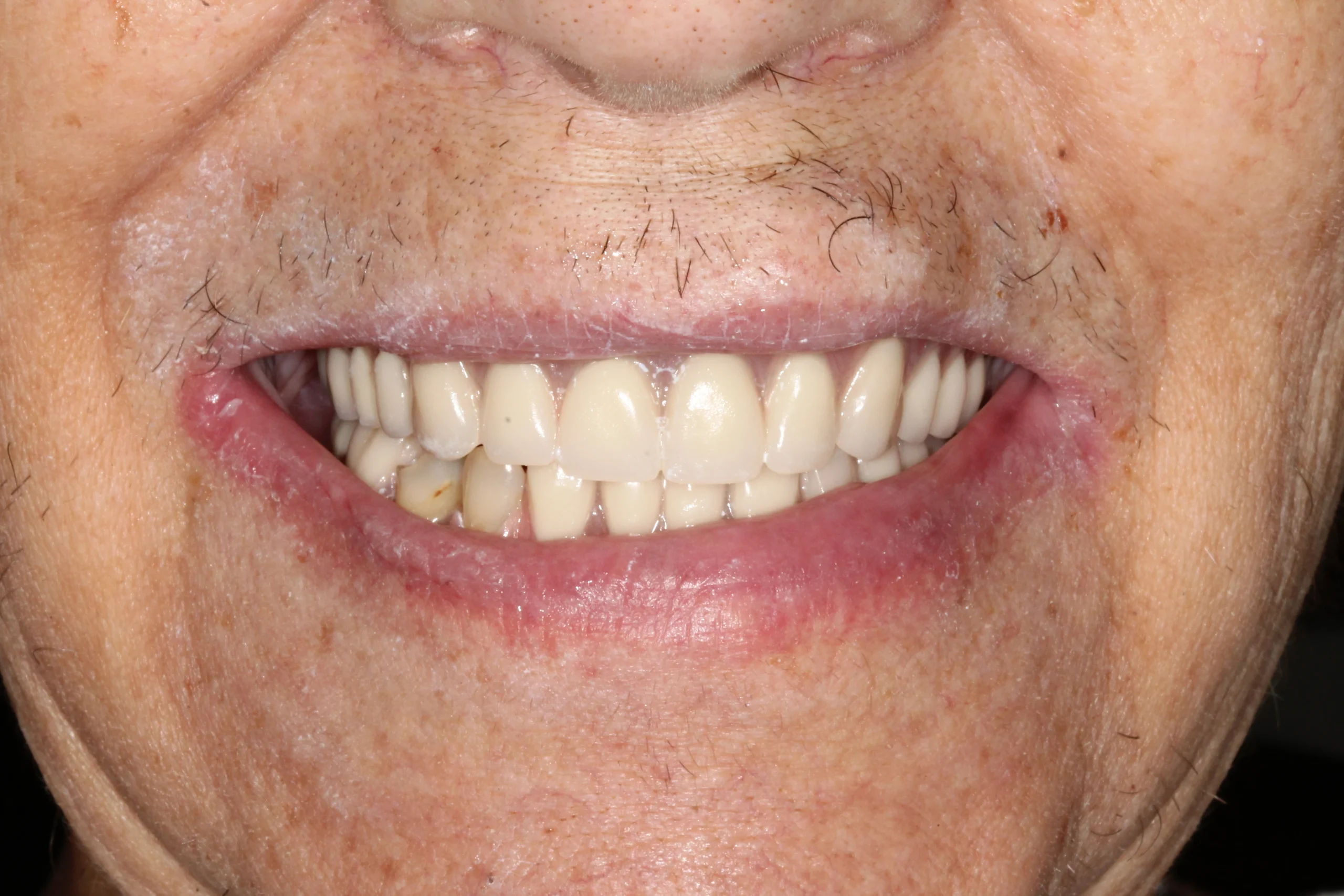 Individual after receiving dentures, showing a restored smile