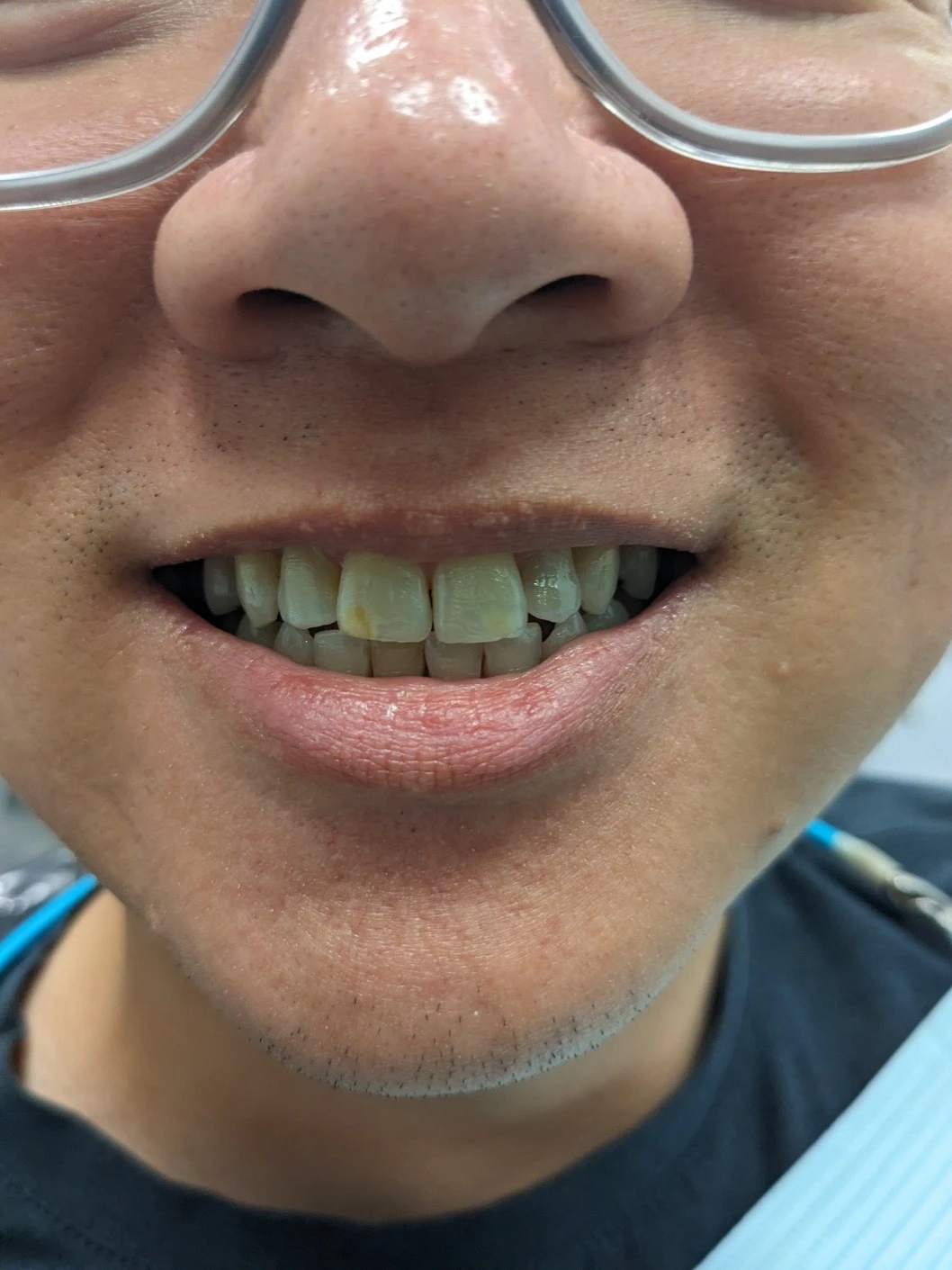 Close-up of discolored teeth in a person wearing glasses, prior to treatment