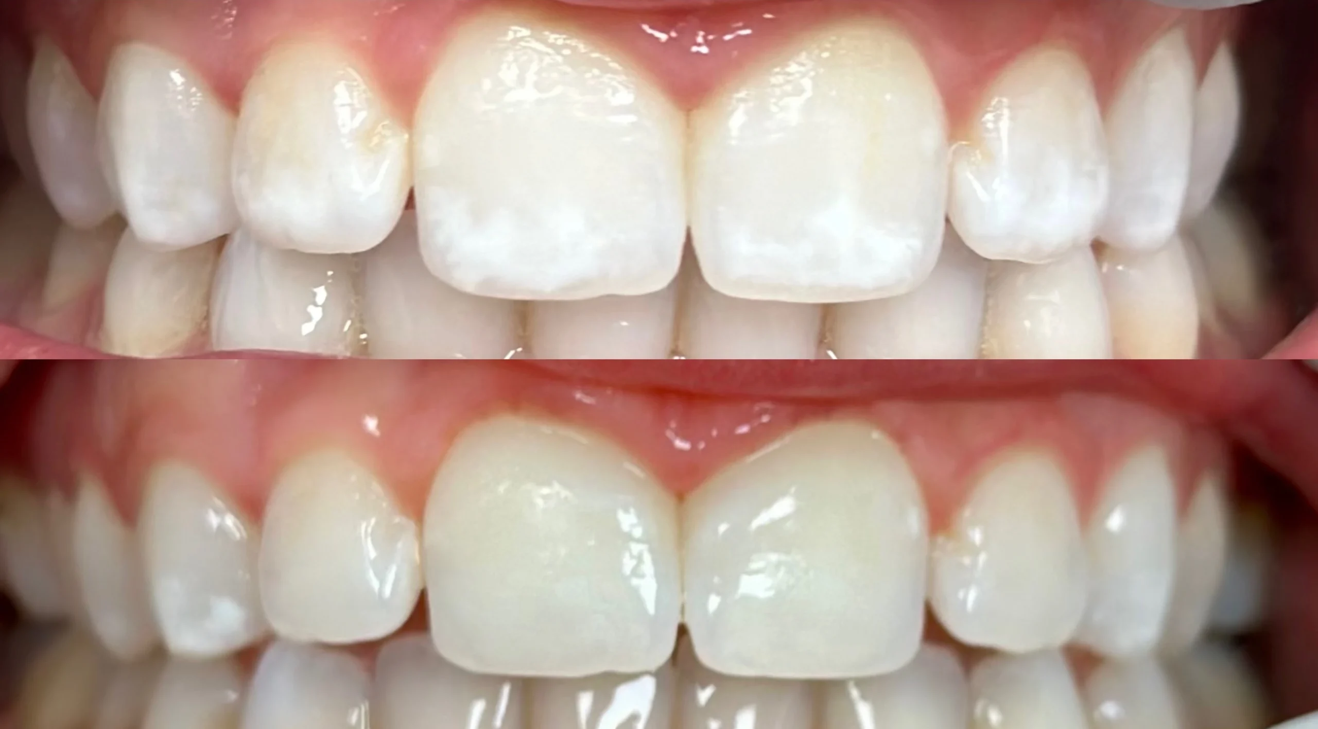 Before-and-after comparison of ICON treatment results on a set of teeth